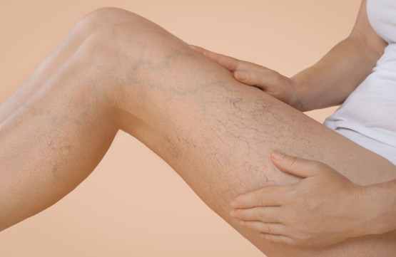 How to Get Rid of Spider Veins